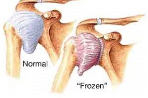 frozen-shoulder-schouderpijn-anatomie